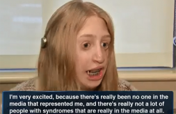 Close-up of Emily Cihla speaking to a television news reporter about her Treacher Collins Syndrome