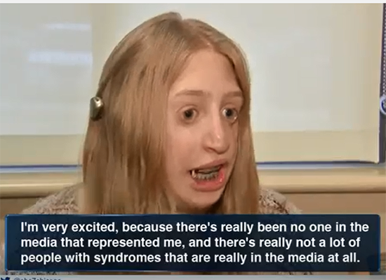 Close-up of Emily Cihla speaking to a television news reporter about her Treacher Collins Syndrome